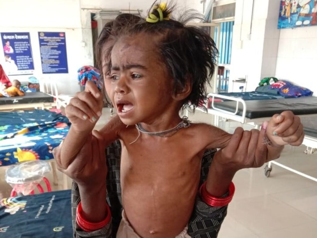 Dhar Malnutrition: धार में 25 हजार बच्चे कुपोषित, 5 हजार से ज्यादा SAM श्रेणी में; पोषण व्यवस्था पर उठे सवाल 1 orig 251670862246639755a658303img 20221209 wa0021 1670881229